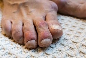 यूरिक एसिड की समस्या से ऐसे पाएं आसानी से छुटकारा